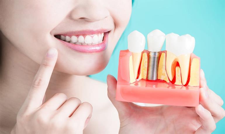 چه زمانی به ایمپلنت دندان نیاز دارید؟